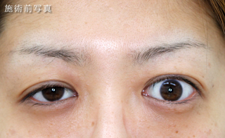 眼瞼下垂　症例写真追加（三白眼）