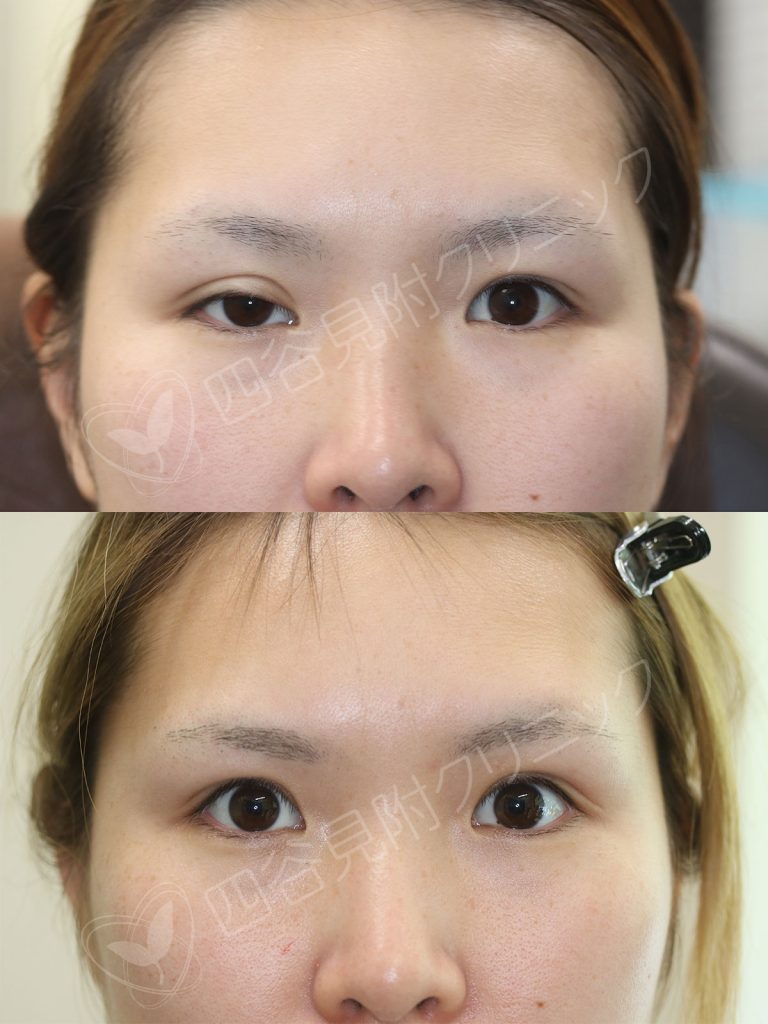 症例写真：３０代：女性・両側腱膜性眼瞼下垂