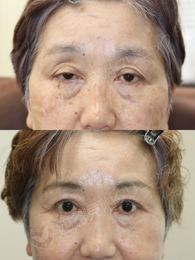 症例写真：６０代：女性・両側ハードコンタクト性眼瞼下垂