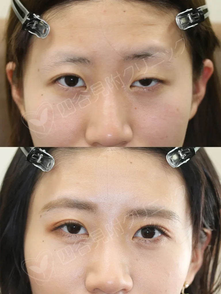 10代:女性・左側先天性眼瞼下垂症症例写真