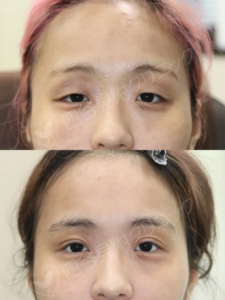 20代:女性・両側腱膜性眼瞼下垂症症例写真