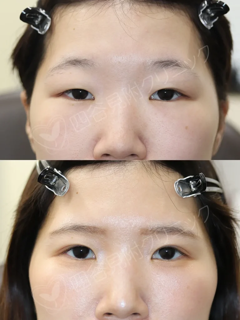 20代:女性・両側腱膜性眼瞼下垂症症例写真