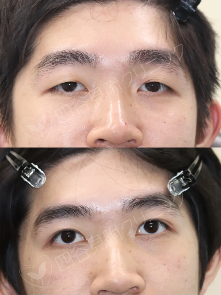 10代:男性・両側腱膜性眼瞼下垂症症例写真