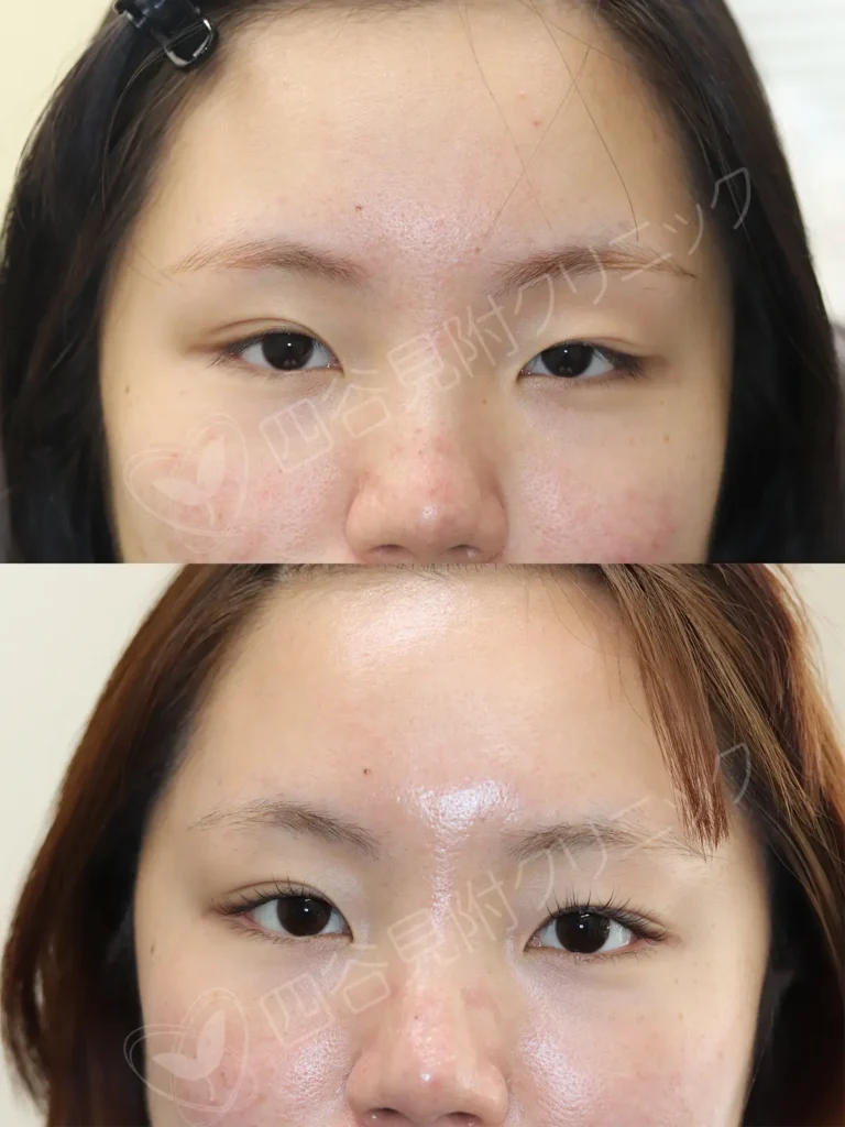 20代:女性・左先天性眼瞼下垂症(他院修正)症例写真