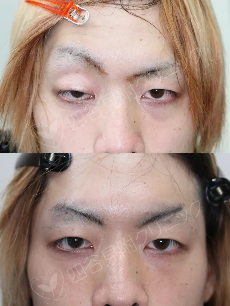 20代:男性・右側先天性眼瞼下垂症(他院修正)症例写真