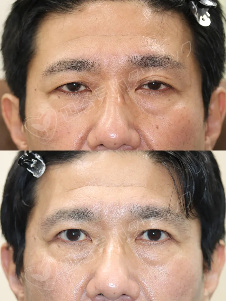 50代:男性・両側腱膜性眼瞼下垂症症例写真