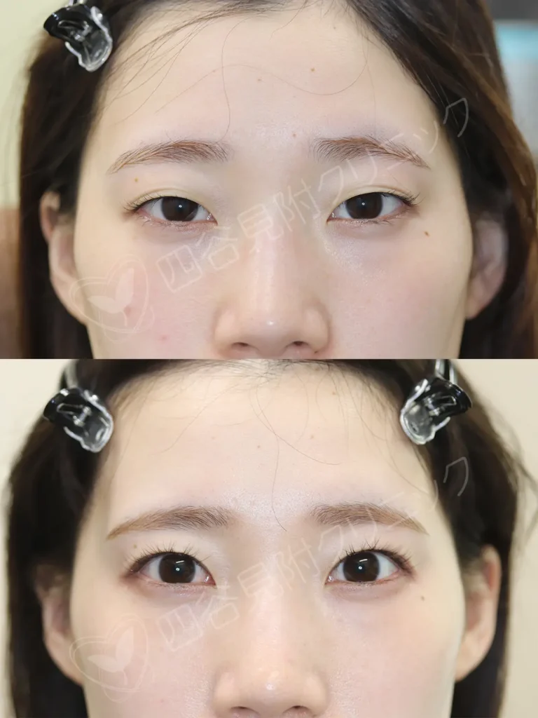 20代:女性・両側腱膜性眼瞼下垂症症例写真