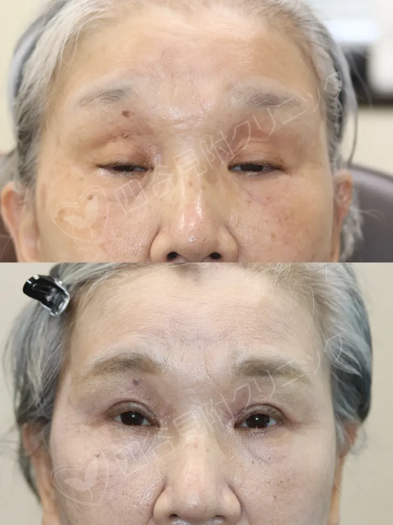 60代:女性・両側腱膜性眼瞼下垂症症例写真